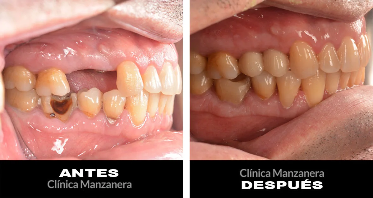 Antes y después: reposición de premolares con implantes dentales