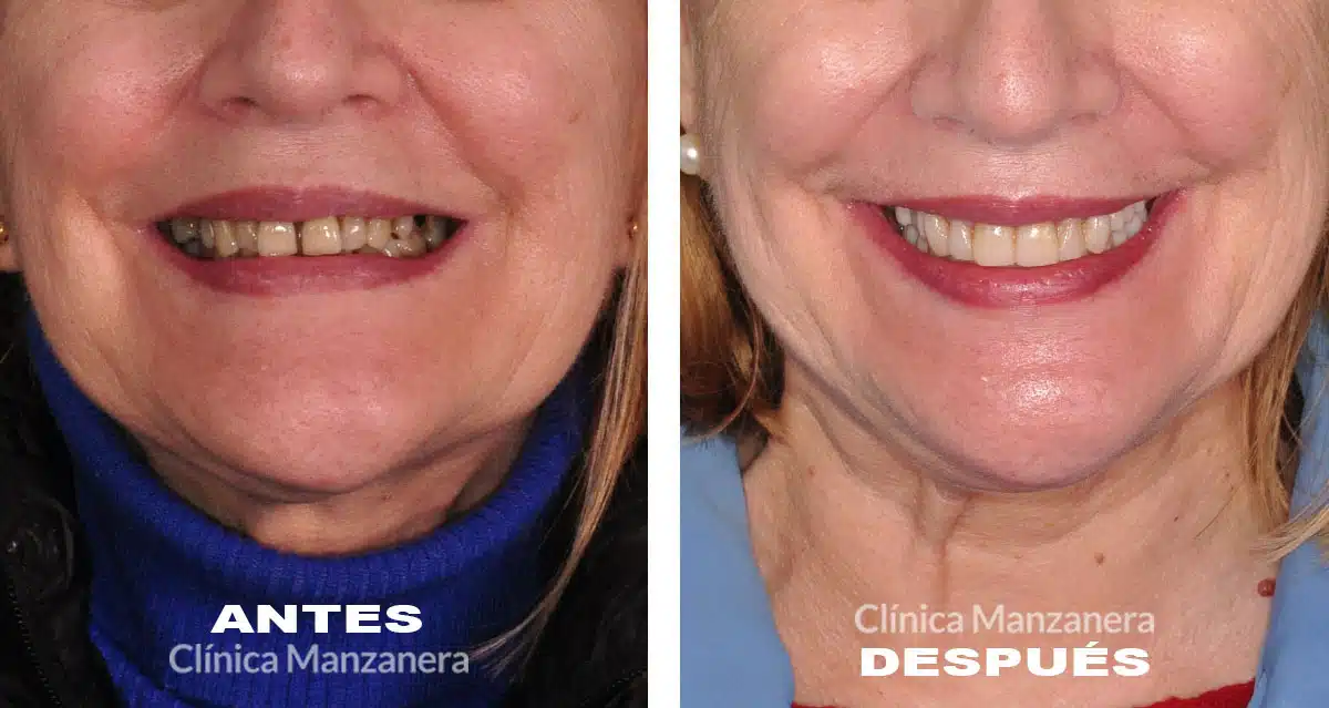 Antes y después: implantes dentales y carillas de composite