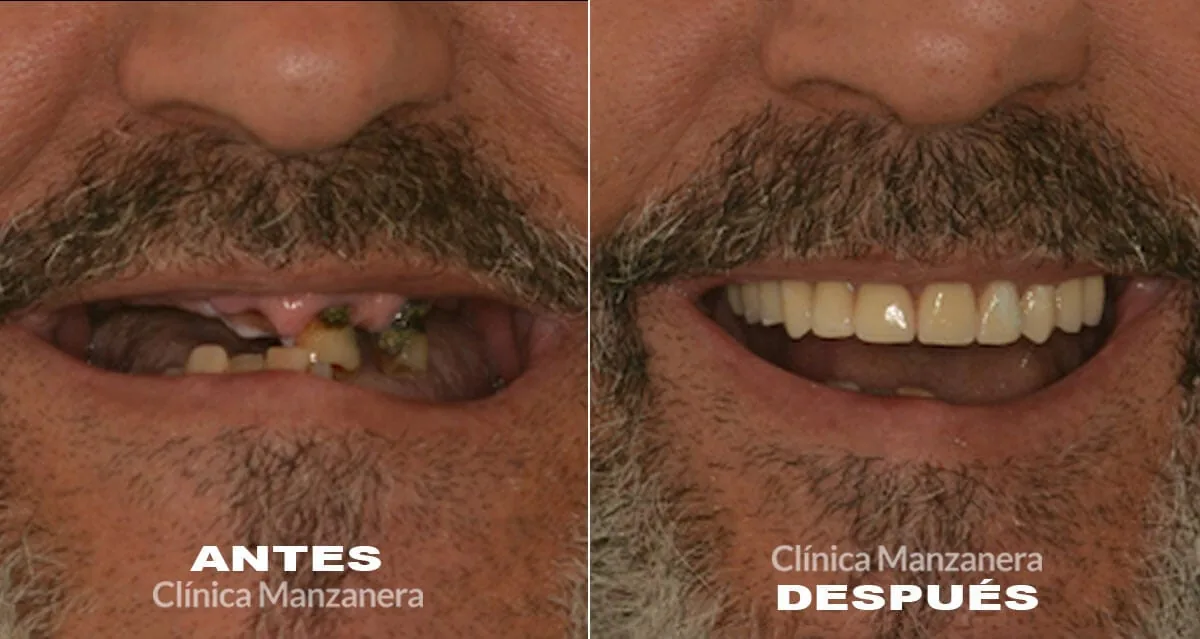 Antes y después: implantes dentales inmediatos