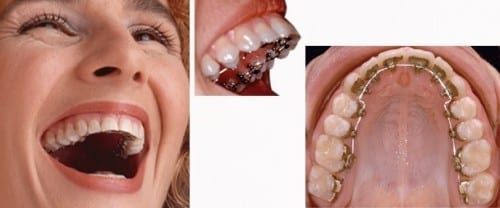 Ortodoncia lingual 