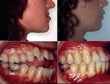 La ortodoncia y la cirugía ortognática combinada pueden lograr resultados espectaculares en los casos más complicados