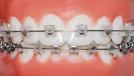 ortodoncia con brackets autoligables