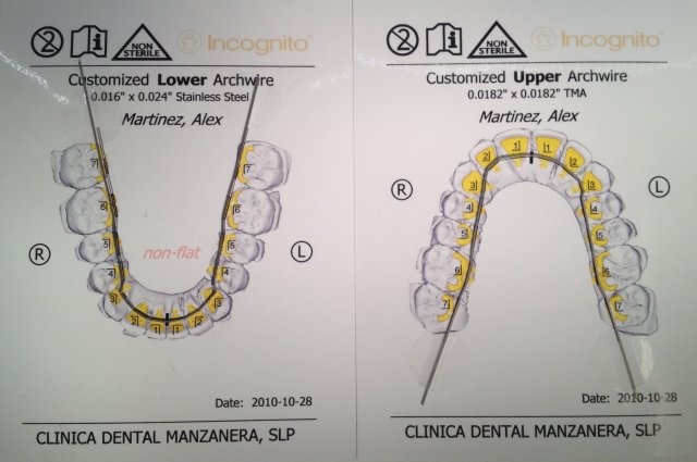Arcos de ortodoncia lingual