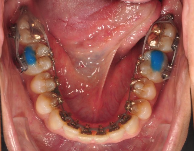 microtornillos ortodoncia