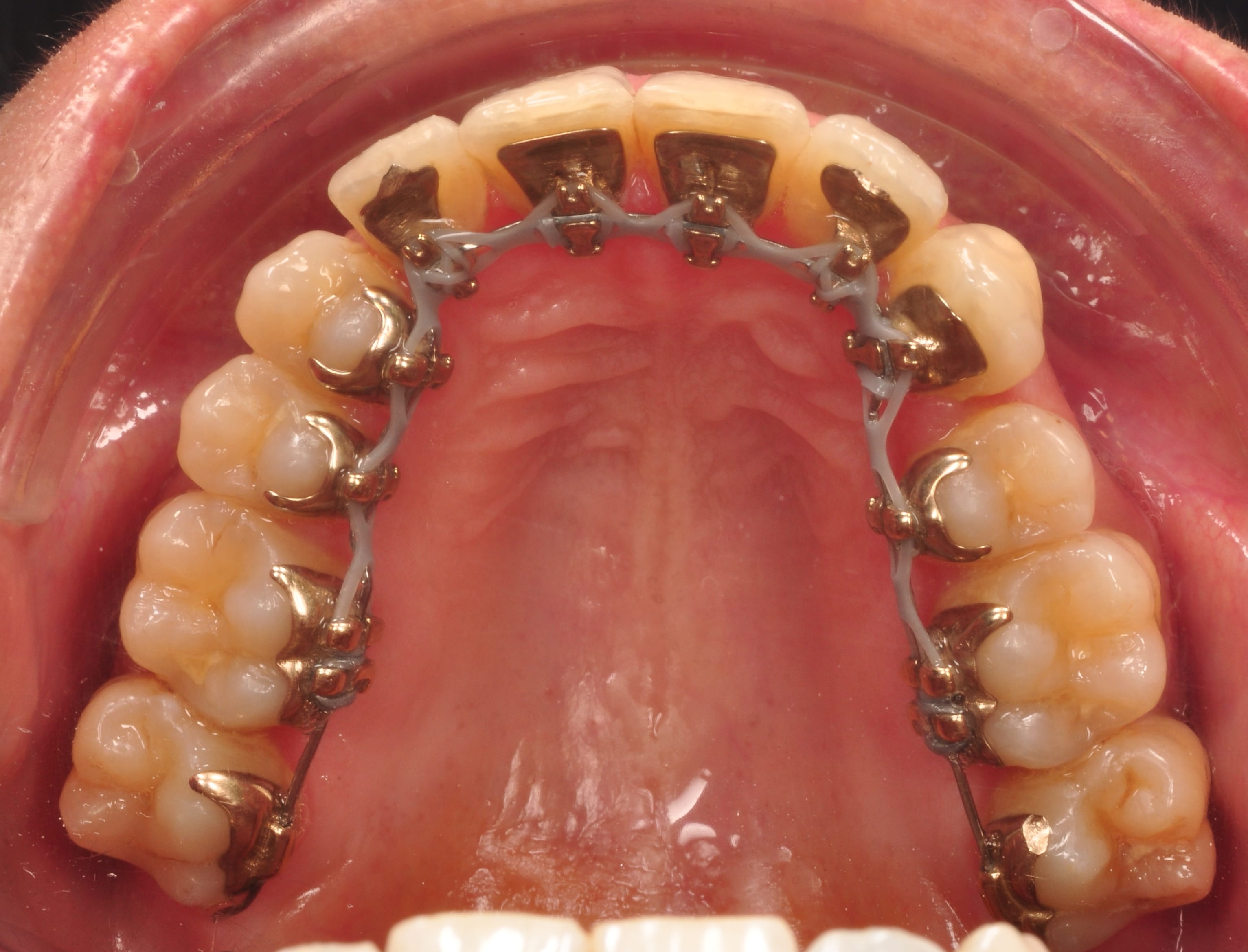 brackets linguales