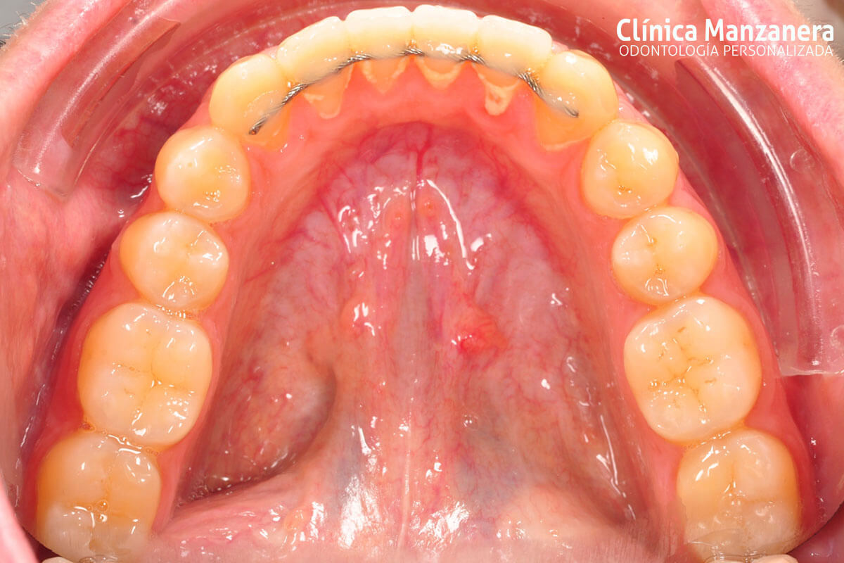 Clase III Ortodoncia resuelto con cirugia ortognatica y ortodoncia