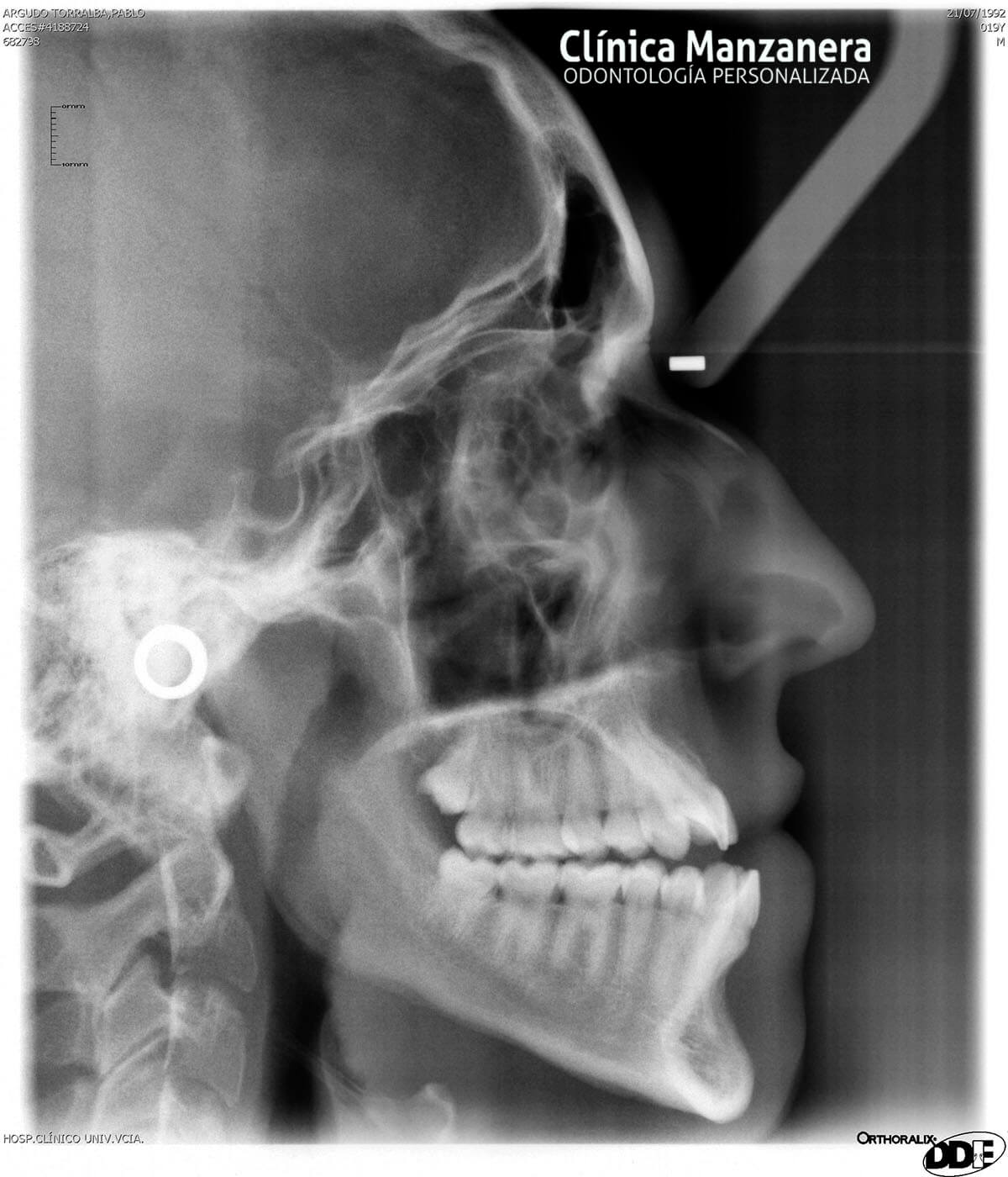 Clase III Ortodoncia resuelto con cirugia ortognatica y ortodoncia