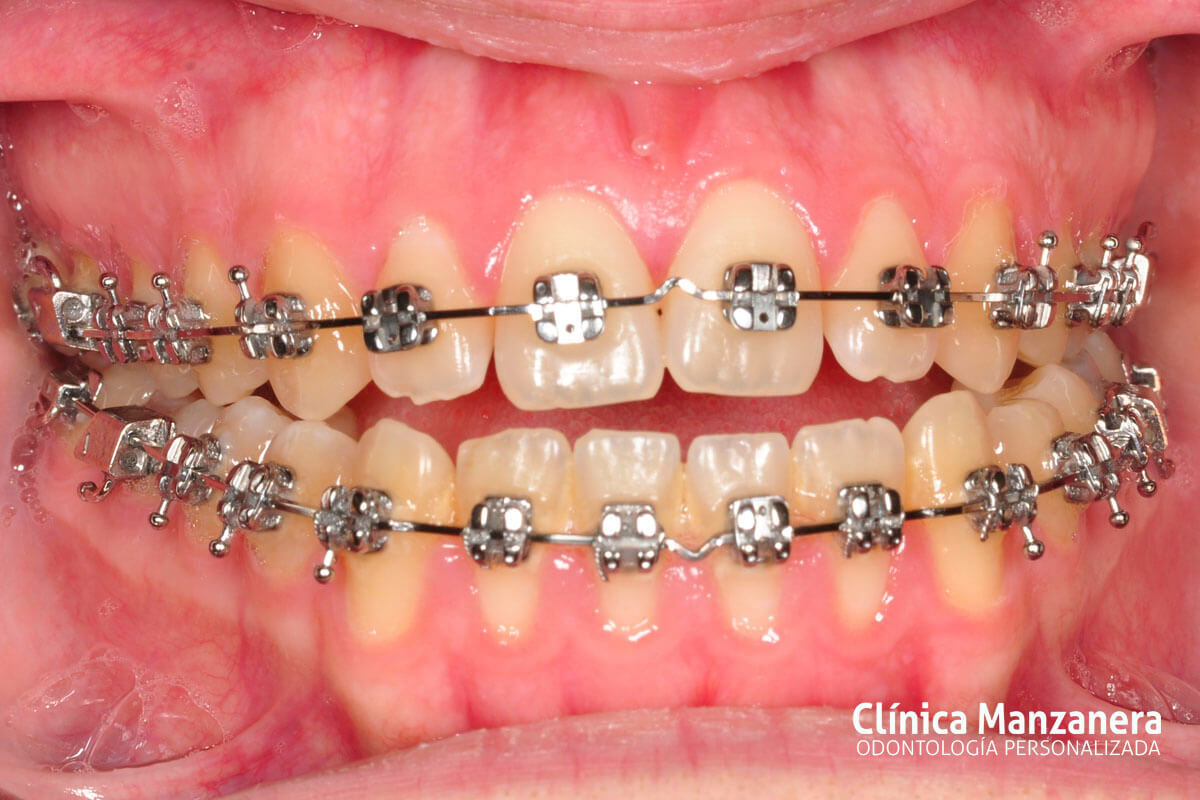 Clase III Ortodoncia resuelto con cirugia ortognatica y ortodoncia