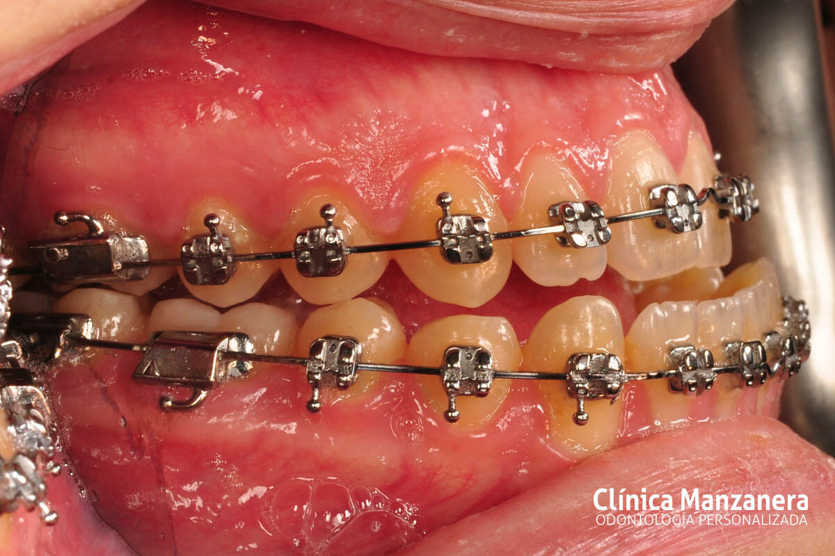 Clase III Ortodoncia resuelto con cirugia ortognatica y ortodoncia