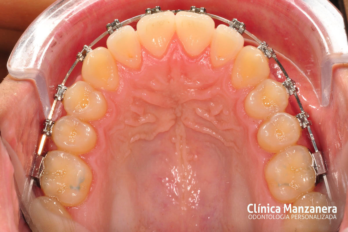 Clase III Ortodoncia resuelto con cirugia ortognatica y ortodoncia