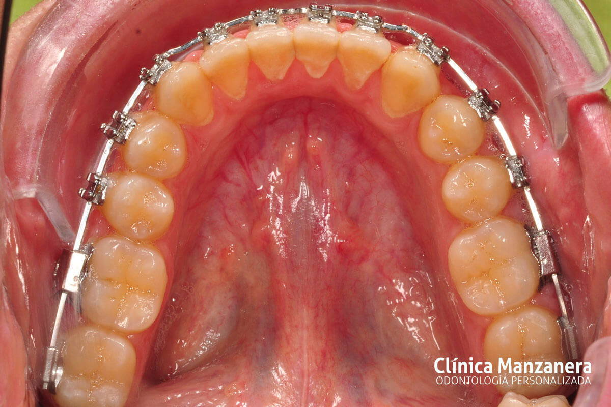 Clase III Ortodoncia resuelto con cirugia ortognatica y ortodoncia