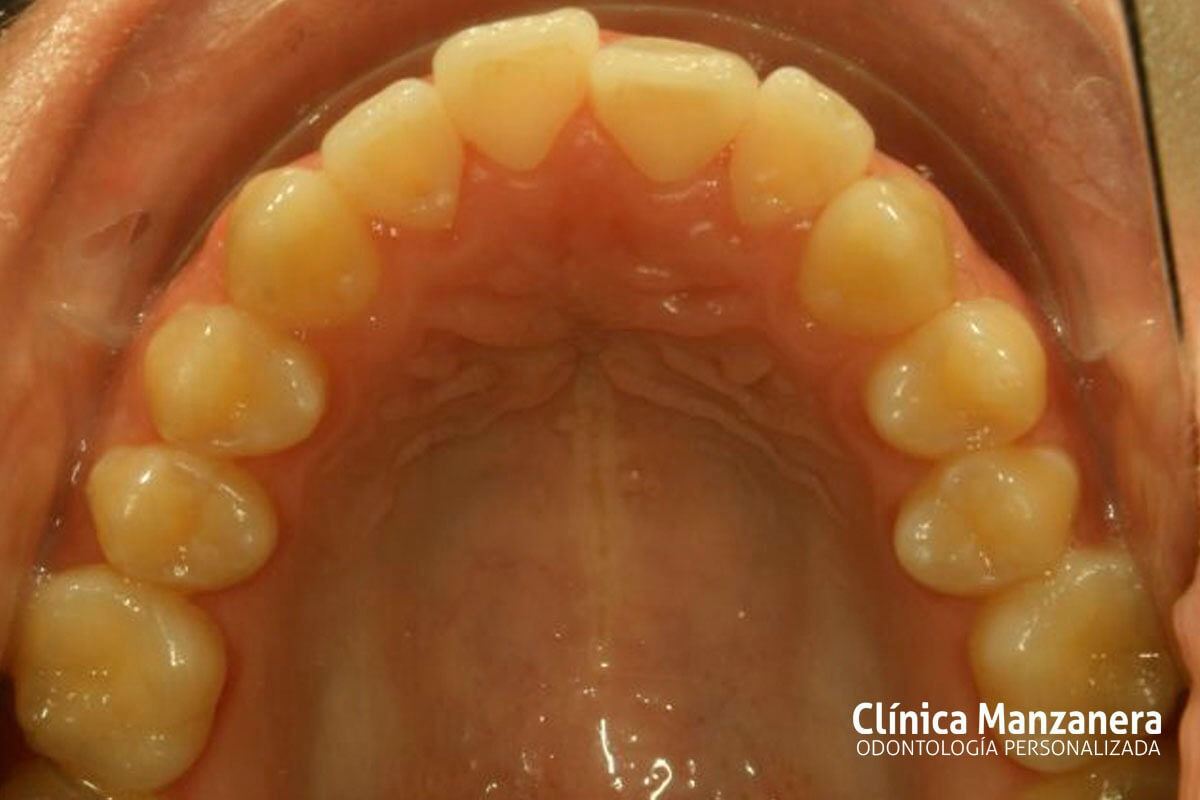 Clase III Ortodoncia resuelto con cirugia ortognatica y ortodoncia