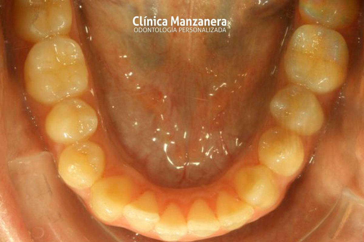 Clase III Ortodoncia resuelto con cirugia ortognatica y ortodoncia