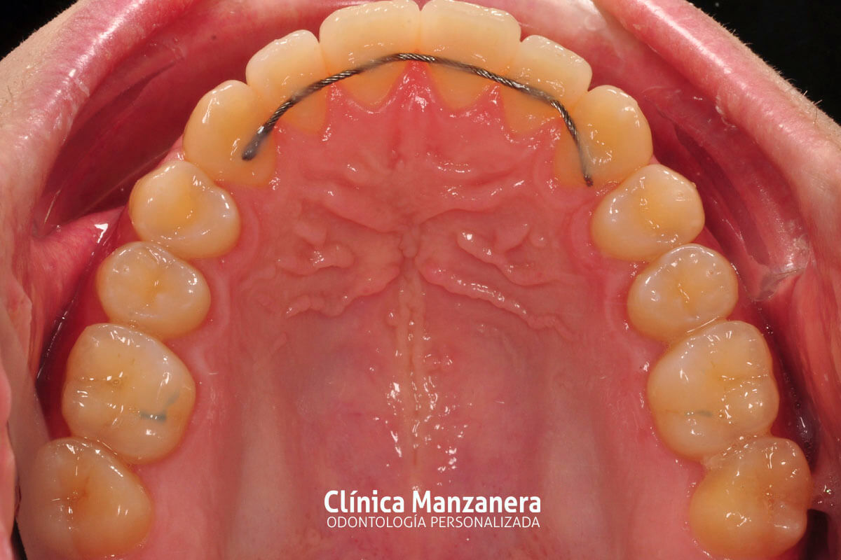 Clase III Ortodoncia resuelto con cirugia ortognatica y ortodoncia