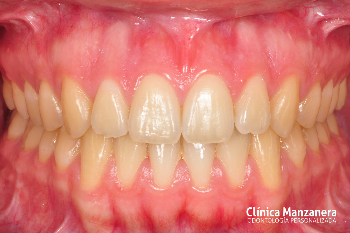 Clase III Ortodoncia resuelto con cirugia ortognatica y ortodoncia