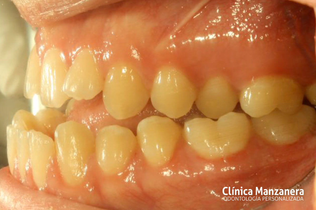 Clase III Ortodoncia resuelto con cirugia ortognatica y ortodoncia