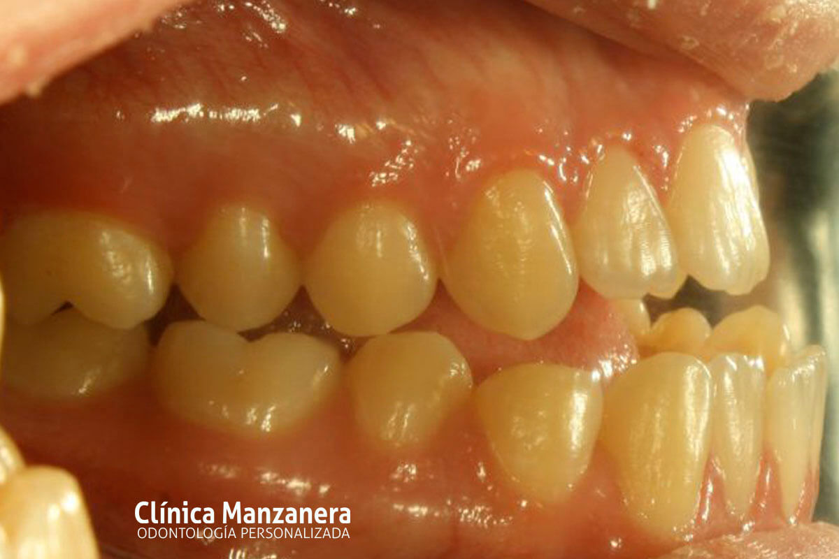 Clase III Ortodoncia resuelto con cirugia ortognatica y ortodoncia