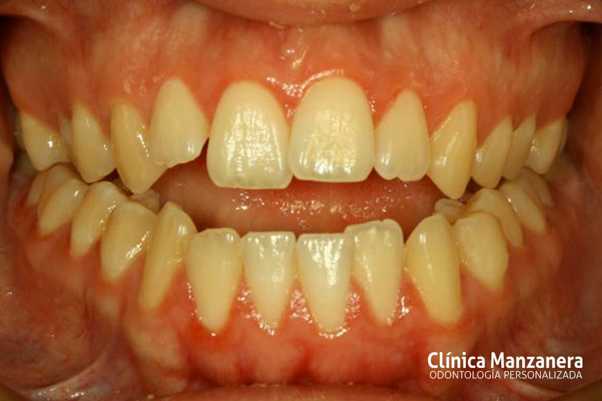 Clase III Ortodoncia resuelto con cirugia ortognatica y ortodoncia