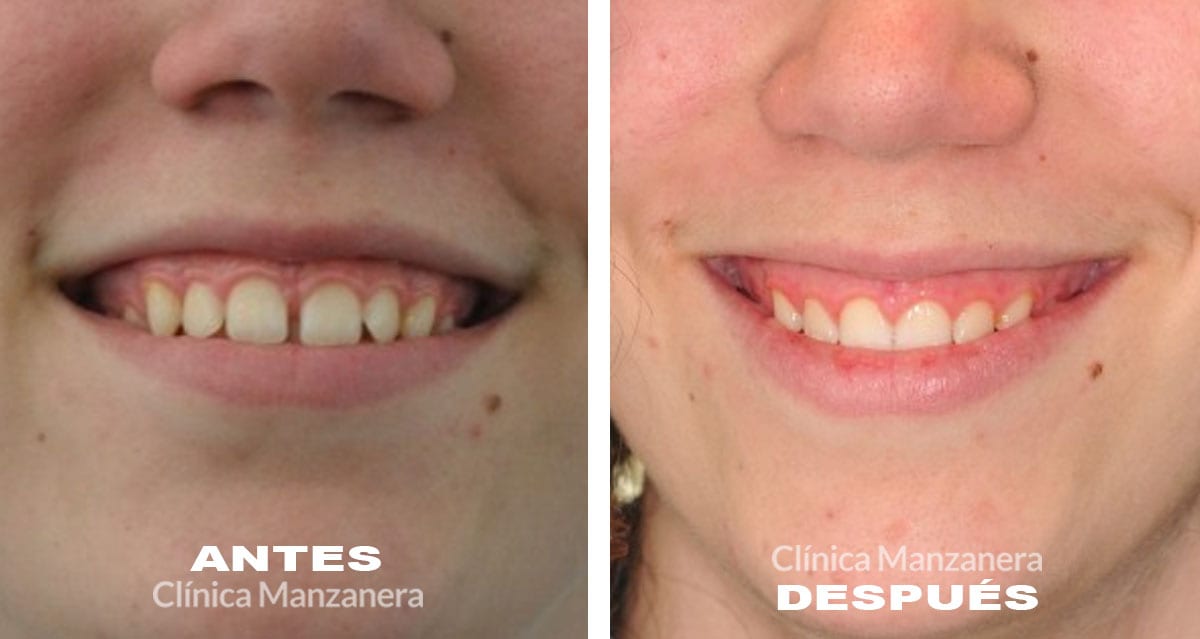 diastema en niños