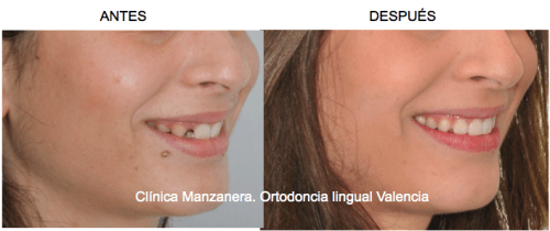 Sonrisa lateral antes y después de la ortodoncia lingual con cierre de espacio para tratamiento de agenesia de incisivo lateral