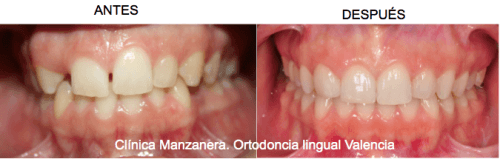 El canino (colmillo) derecho sustituye ahora al incisivo que faltaba, y el primer premolar al colmillo, así se evita ponerse un implante en los dientes anteriores, manteniendo una sonrisa natural cien por cien.