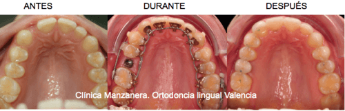 Ortodoncia lingual en Valencia