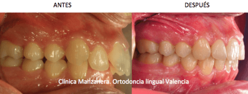 Vista frontal antes y después de la ortodoncia lingual: se ha solucionado la mordida profunda, el resalte aumentado, el apiñamiento y la clase 2