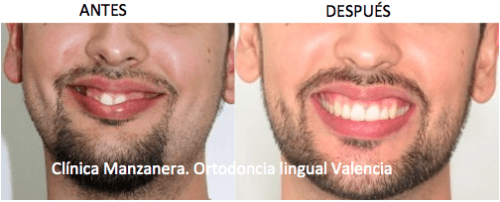Sonrisa antes y después de la ortodoncia lingual