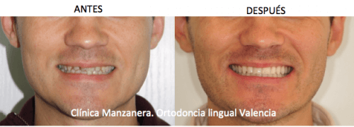 Sonrisa antes y después de la ortodoncia lingual tras un año y medio de tratamiento