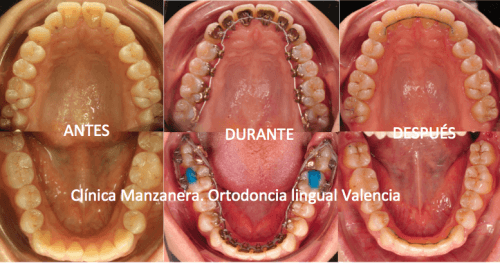 Proceso de tratamiento antes, durante y después de la ortodoncia lingual con la retención fija colocada.