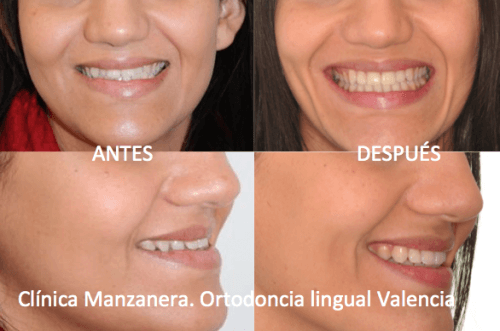 Sonrisa antes y después de la ortodoncia lingual