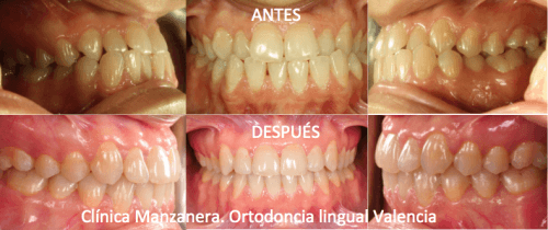 Resultado de frente y lateral antes y después de la ortodoncia lingual