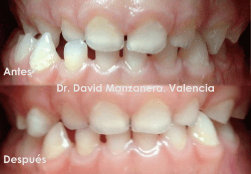 Ortodoncia valencia, clínica dental valencia, ortodoncia niños