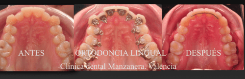 Antes y después de la ortodoncia lingual