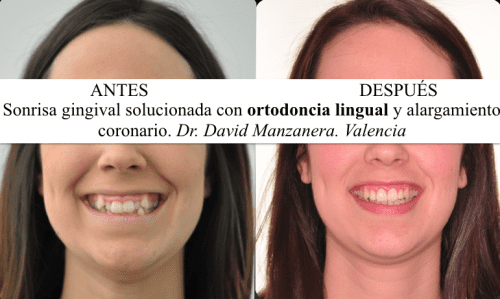 Sonrisa gingival solucionada con ortodoncia lingual y alargamiento de corona