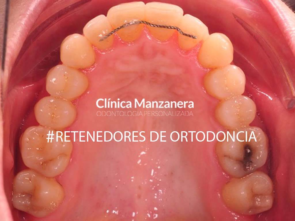 Juguetón Tradicional presupuesto Retenedores Dentales: Tipos de Retenedores Ortodoncia