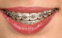 Brackets dentales embandados