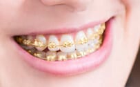 brackets de oro