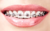 brackets metalicos