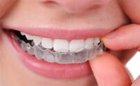 ortodoncia invisalign