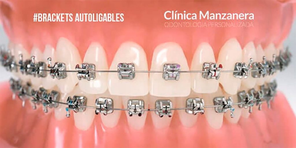 Brackets Autoligables Ventajas vs Inconvenientes