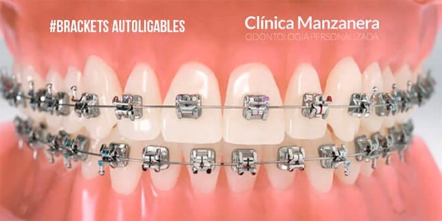 brackets autoligables o autoligantes