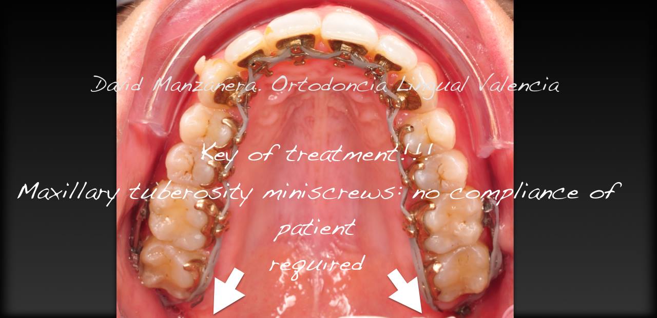 ortodoncia-lingual-microtornillos-2