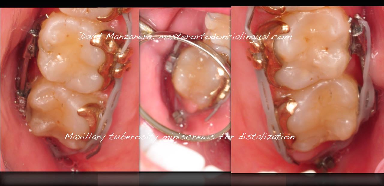 ortodoncia-lingual-microtornillos-3