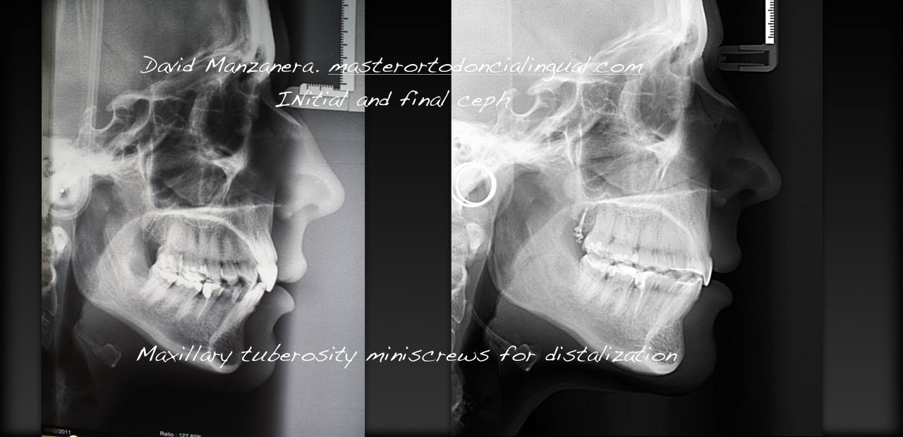 ortodoncia-lingual-microtornillos-6