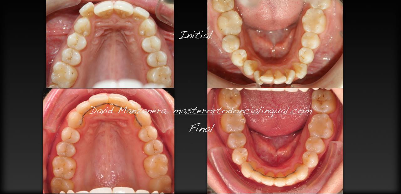 ortodoncia-lingual-microtornillos-7