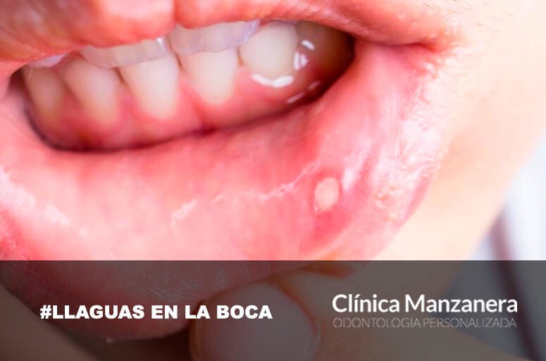 Llagas la Boca: Causas y Remedios Clínica Manzanera