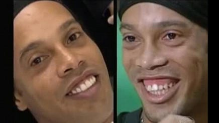 Ronaldinho sonrisa gingival