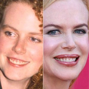 sonrisa gingival Nicole Kidman