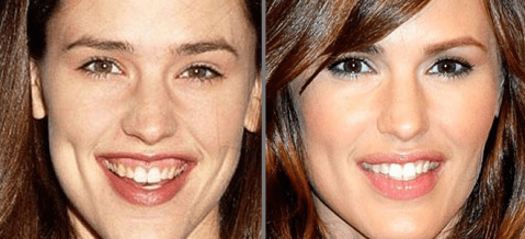 sonrisa gingival jennifer garner